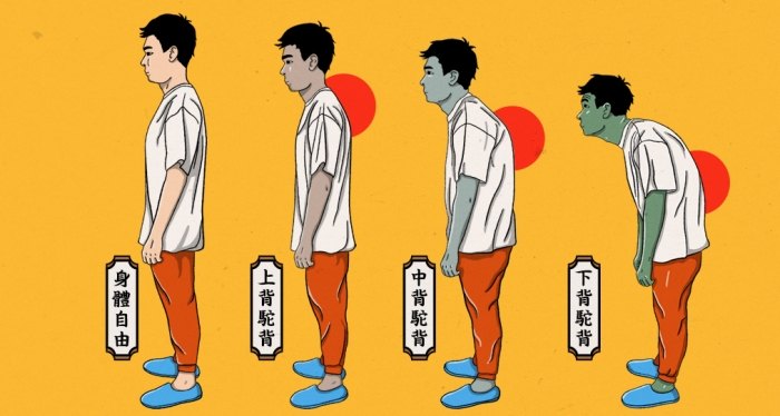 駝背治療