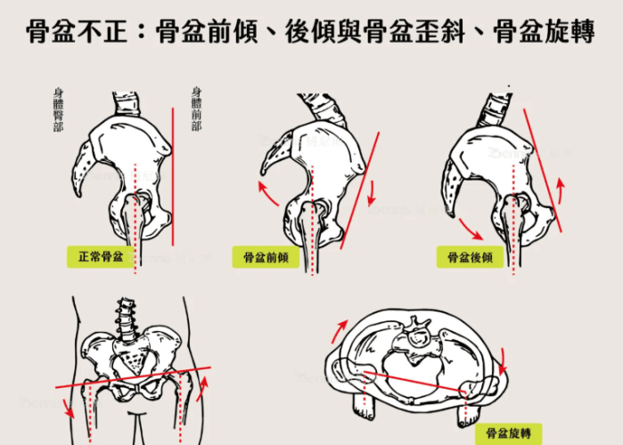 骨盆歪斜