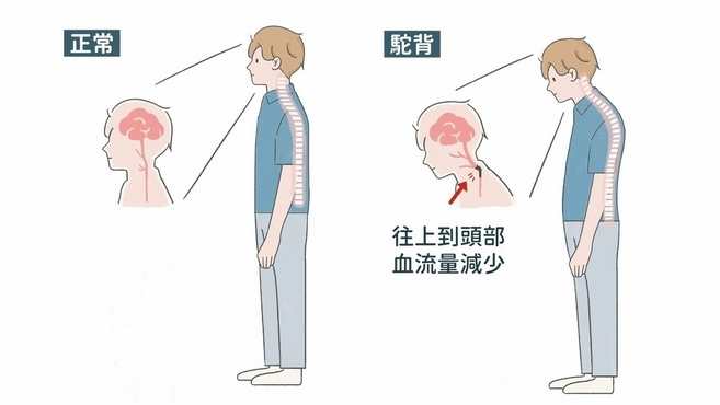 駝背原因
