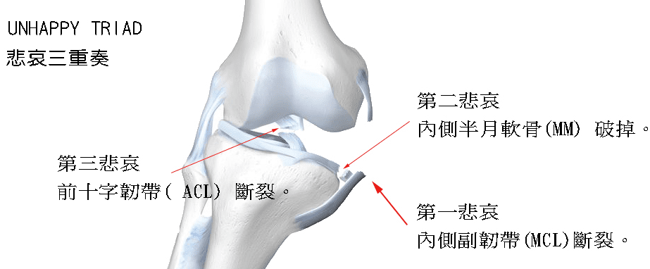 膝蓋韌帶拉傷分3級