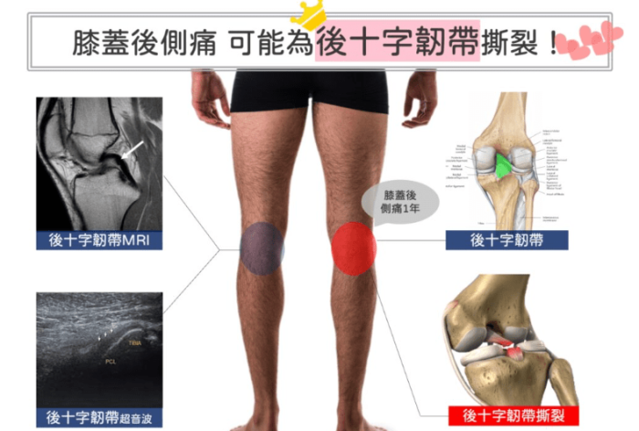 為什麼韌帶會受傷、斷裂